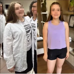 Antes e depois de paciente que emagreceu com acompanhamento nutricional